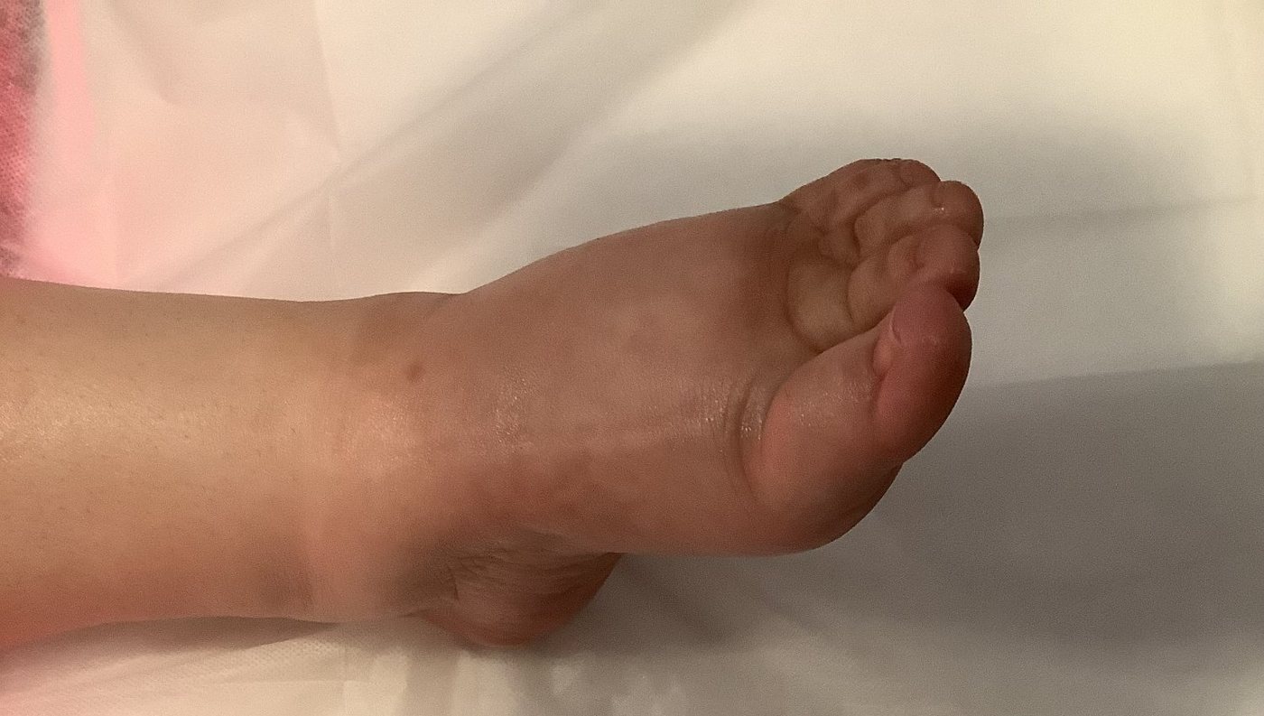 Before lymphatic massage — swollen foot with chronic edema